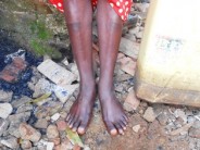 The marks of the gum boots on Janet's legs, because she has worn the gum boots for a long time because of the consistent water flooding her and others' houses